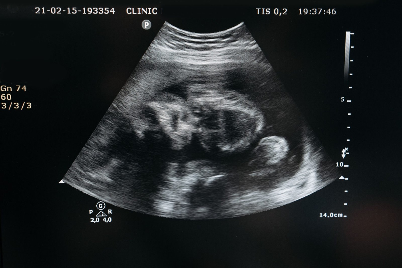 99.9 percent accurate gender determination ultrasound display screen at 14 weeks gestation.
